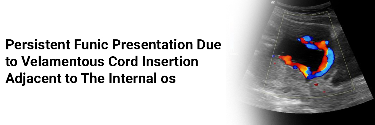 Persistent funic presentation due to velamentous cord insertion adjacent to the internal os