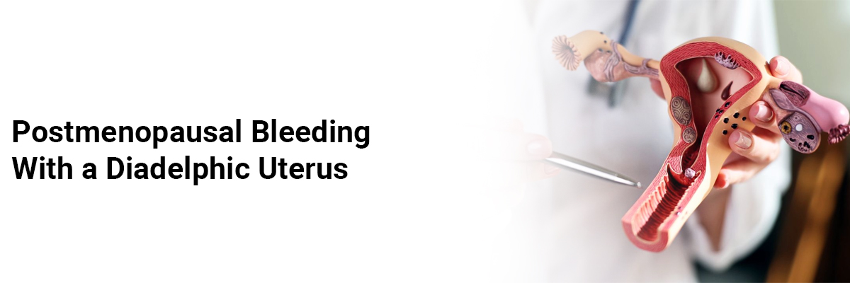 Postmenopausal Bleeding With a Diadelphic Uterus