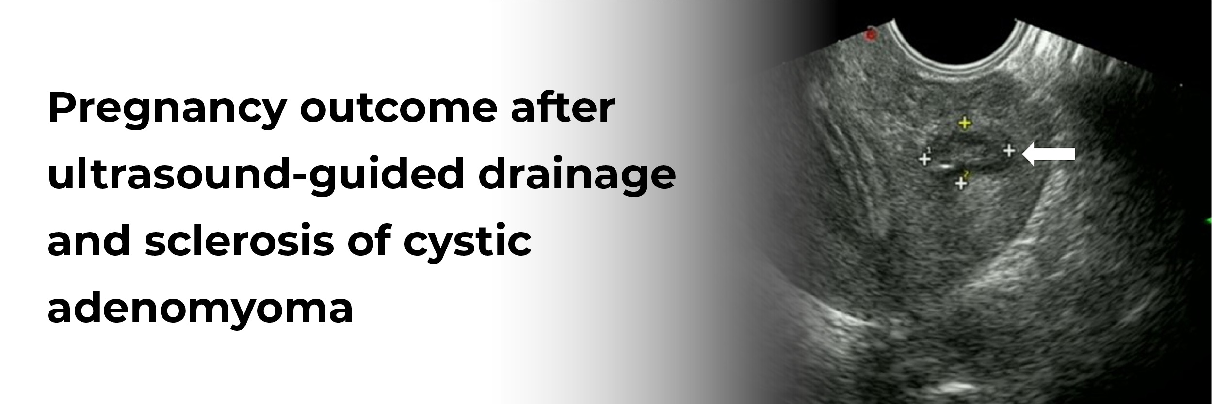 Pregnancy outcome after ultrasound-guided drainage and sclerosis of cystic adenomyoma