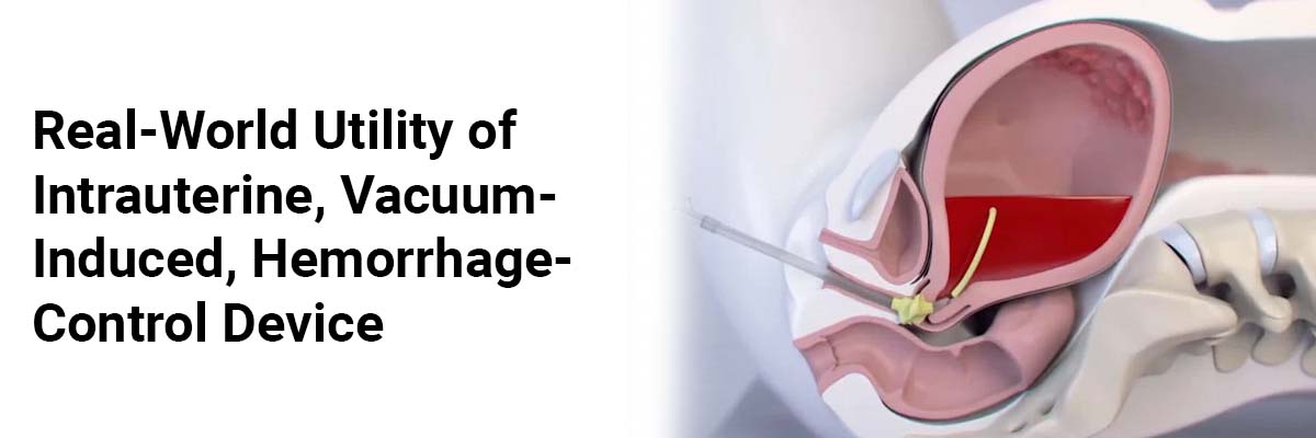 Real-World Utility of Intrauterine, Vacuum-Induced, Hemorrhage-Control Device