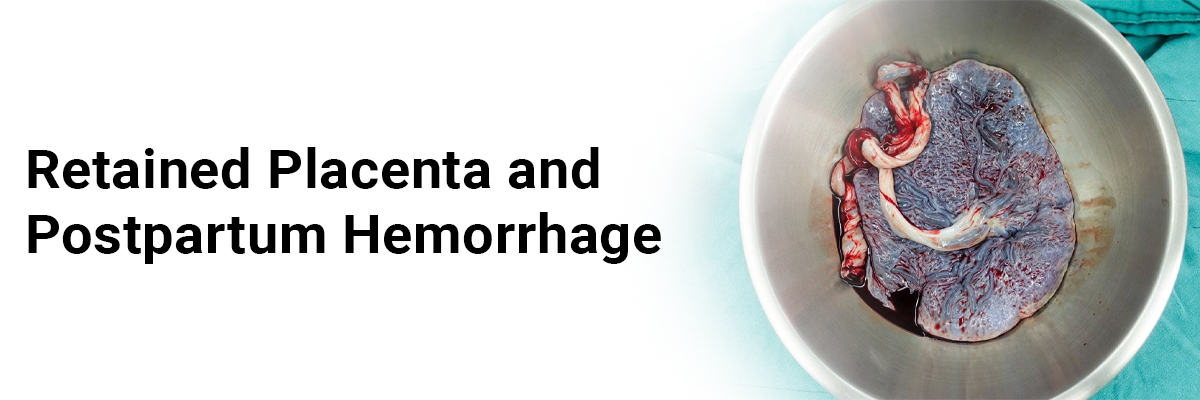 Retained Placenta and Postpartum Hemorrhage
