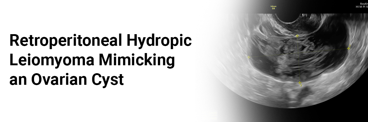 Retroperitoneal Hydropic Leiomyoma Mimicking an Ovarian Cyst