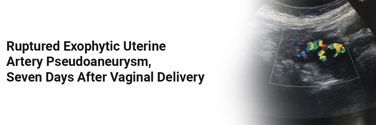 Ruptured Exophytic Uterine Artery Pseudoaneurysm, Seven Days after Vaginal Delivery