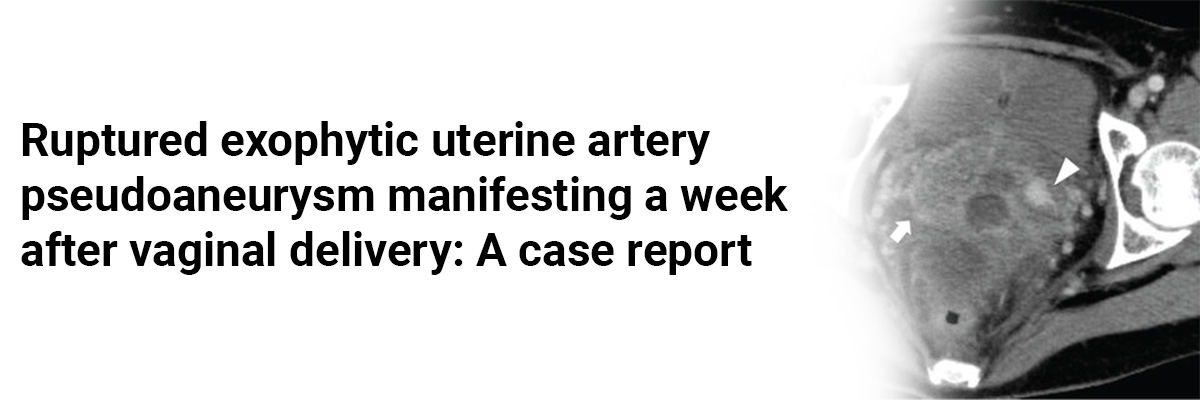 Ruptured exophytic uterine artery pseudoaneurysm manifesting a week after vaginal delivery: A case report