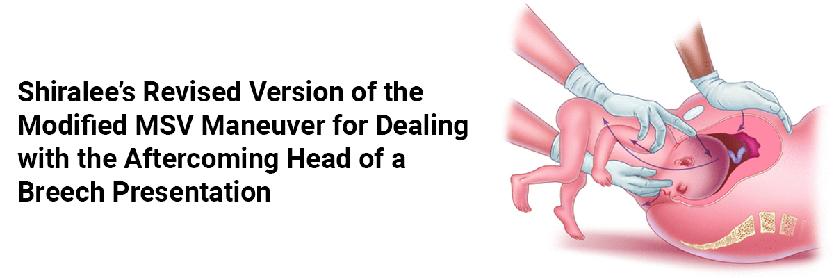 Shiralee's Revised Version of the Modified MSV Maneuver for Dealing with the Aftercoming Head of a Breech Presentation