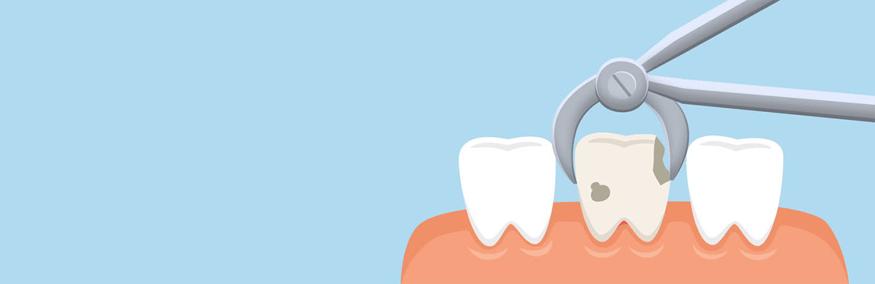 Steps to be taken before Tooth Removal Procedure
