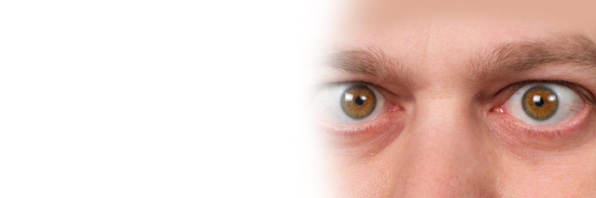 भेंगापन क्या है? प्रकार, कारण, लक्षण और इलाज | Crossed Eye in Hindi