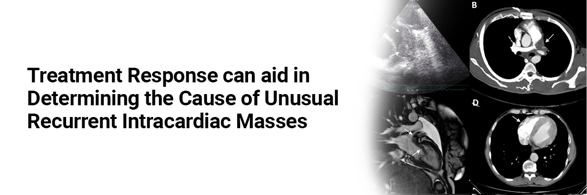 Treatment Response can aid in Determining the Cause of Unusual Recurrent Intracardiac Masses