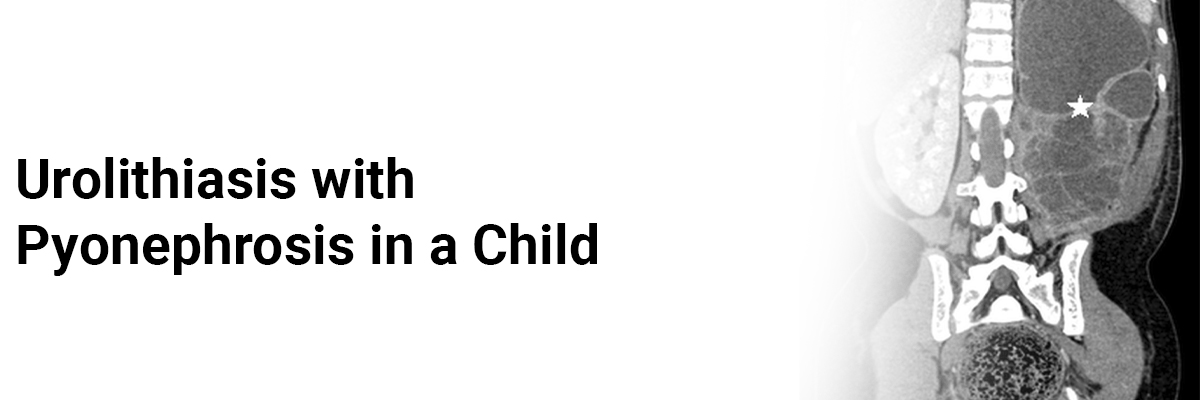 Urolithiasis with pyonephrosis in a child