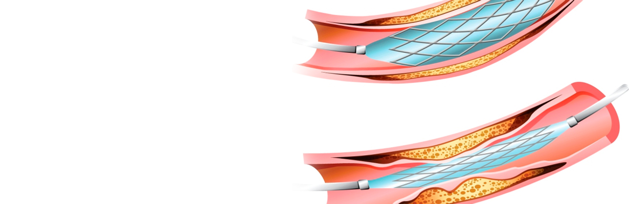 What are the first generation stents?