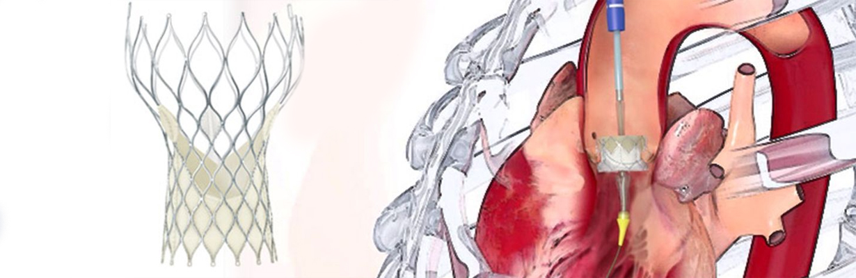 What are the indications for surgery in a case of aortic?
