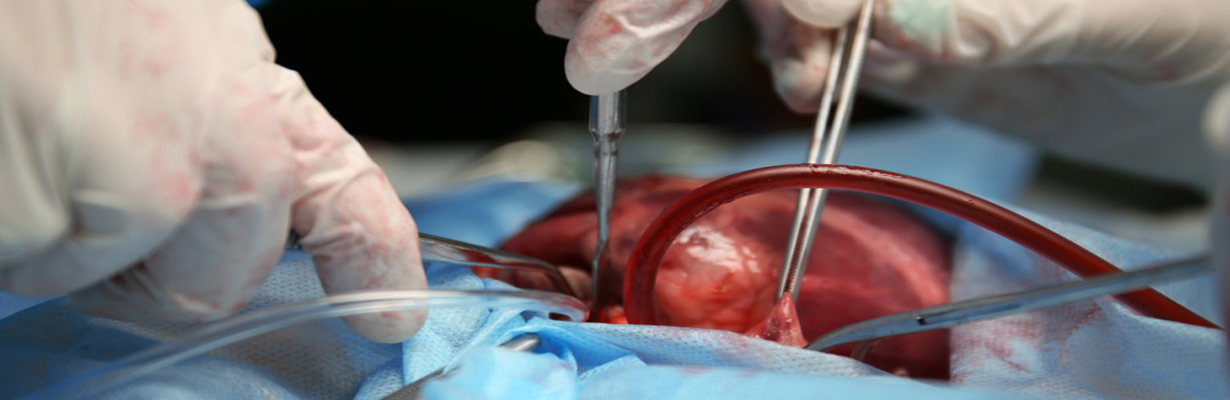 What are the long term results of cardiac transplant?