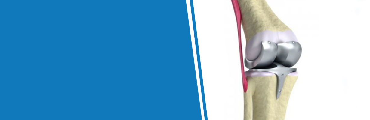 What are the types of orthopedic implants being used and how should we choose an implant?