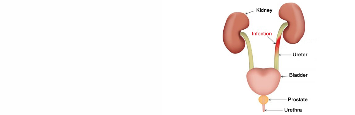 What can cause recurrent urinary infections?