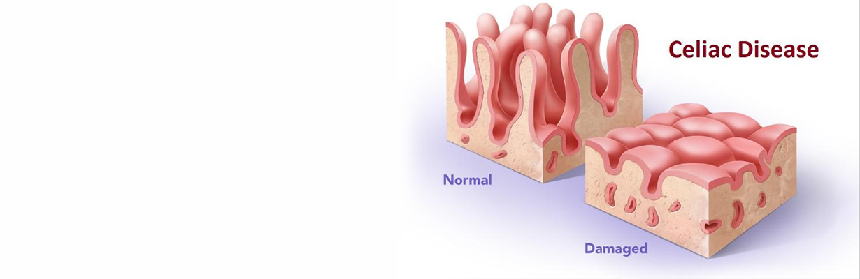 What causes Gluten Intolerance (celiac disease)?