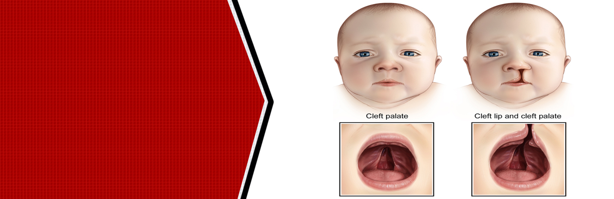 What is Cleft lip and Cleft Palate?