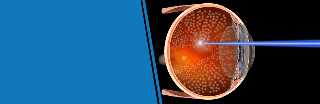 What is Laser Photo Coagulation?