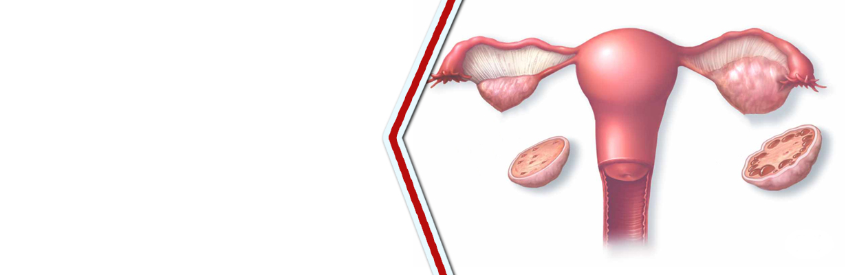 What is PCOS?