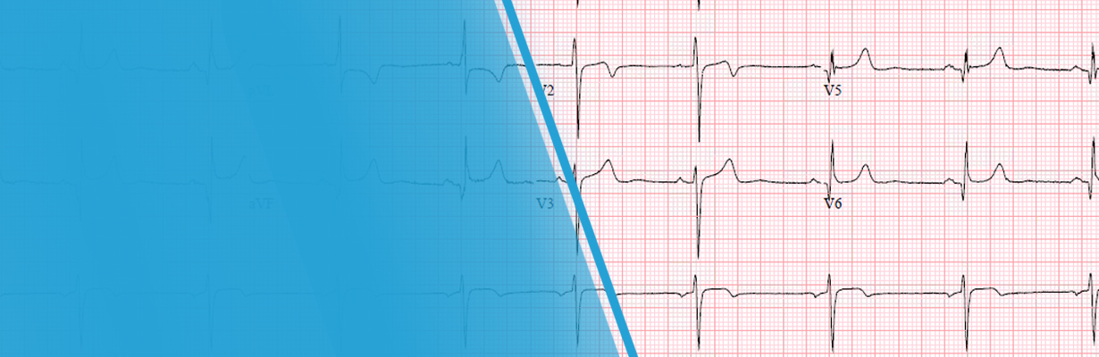 What is ST elevation MI and its preventive measures?