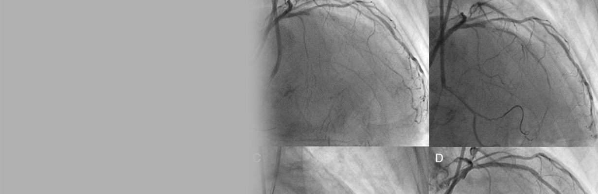 What is best treatment for LAD blockage 80-90%?
