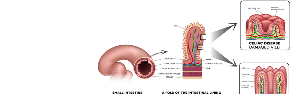 What is celiac disease?