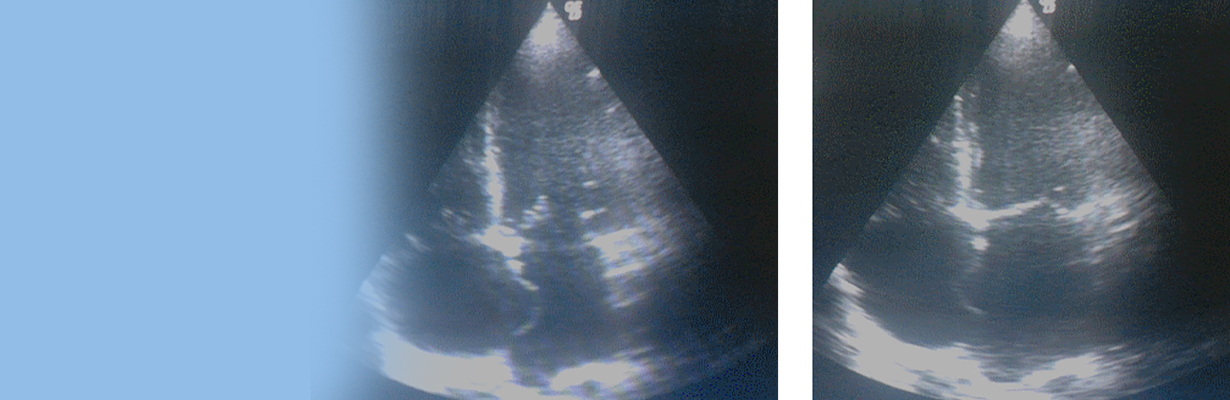 What is interatrial septal aneurysm?