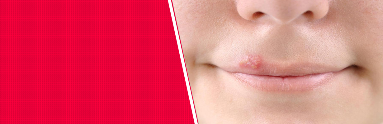 What is pemphigus?