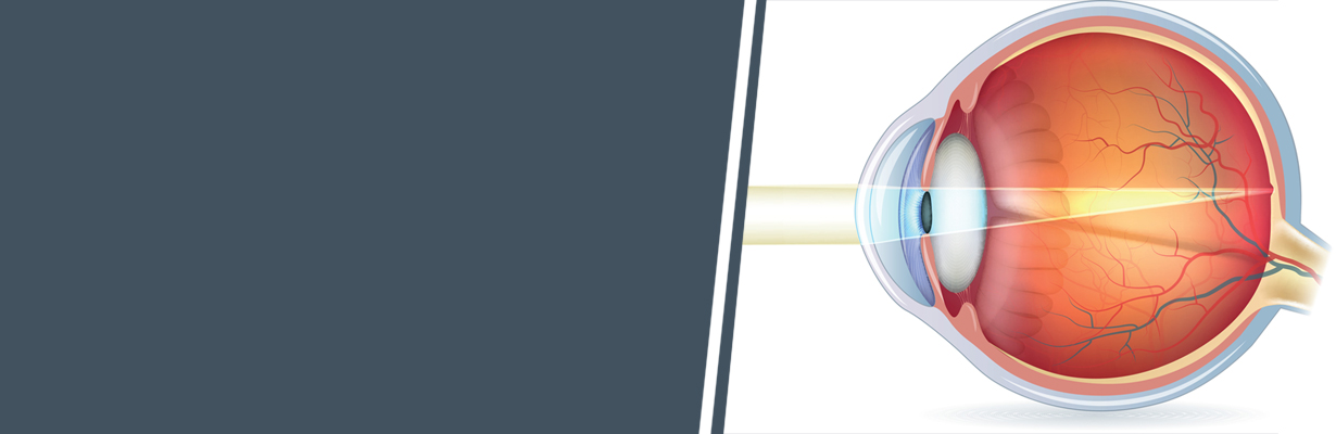 What is refractive error and what are the causes of refractive error?