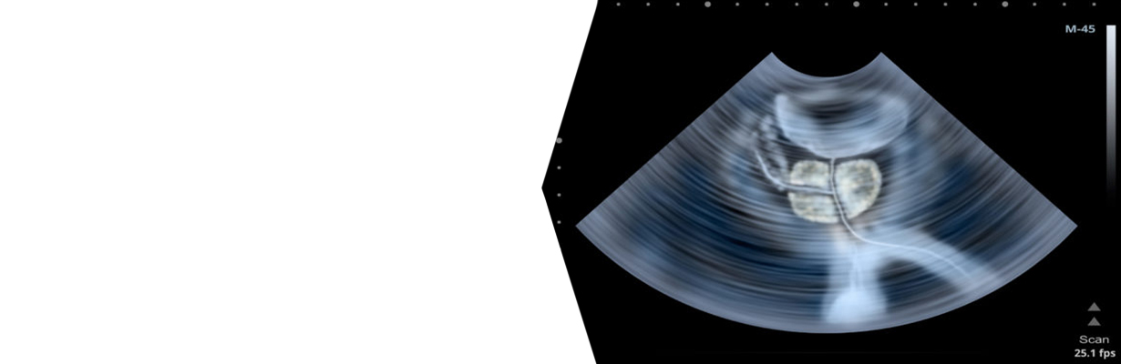 What is residual urine when we examine ultrasound of a prostate?