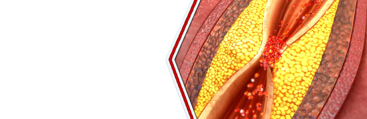 What is stable coronary artery disease?