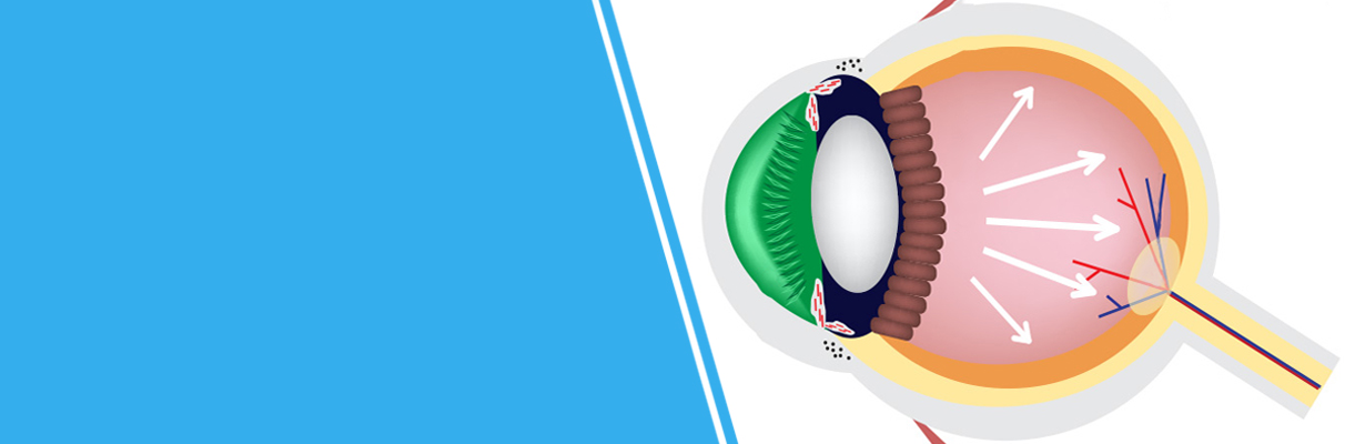 What is target IOP?