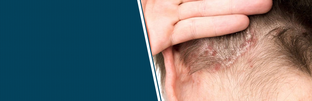 What is the cure for Psoriasis?