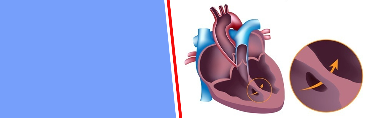 What is ventricular septal defect (VSD)?