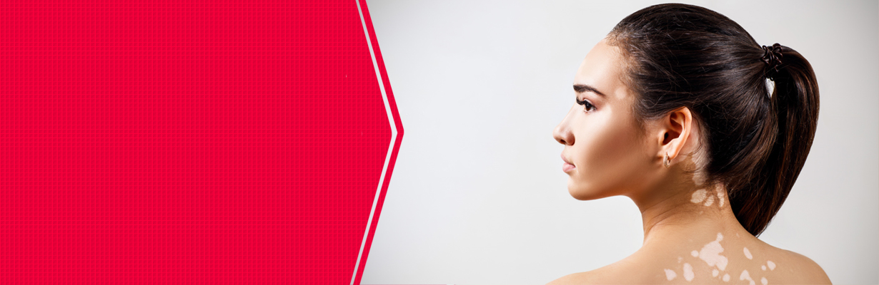 What is vitiligo?