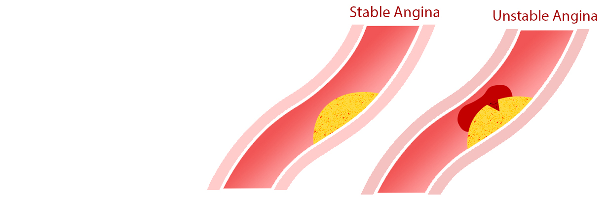 What medical treatment should be given to a patient with stable and unstable angina?