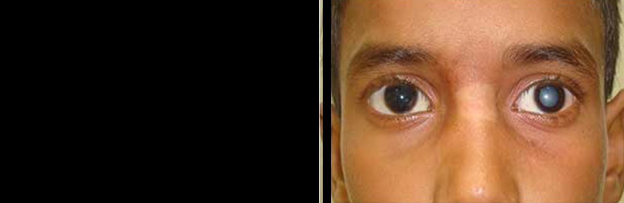 What about Cataract in children?