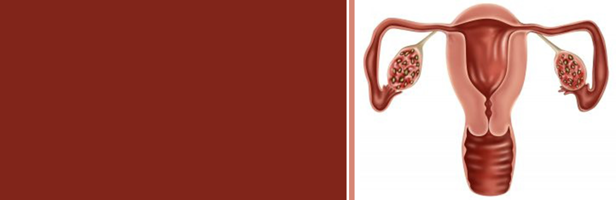 What are the cardial feature for diagnoss of PCOS?