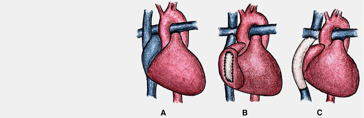 What is fontan surgery?