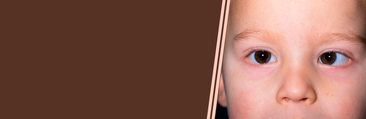 What is Strabismus or Squint?