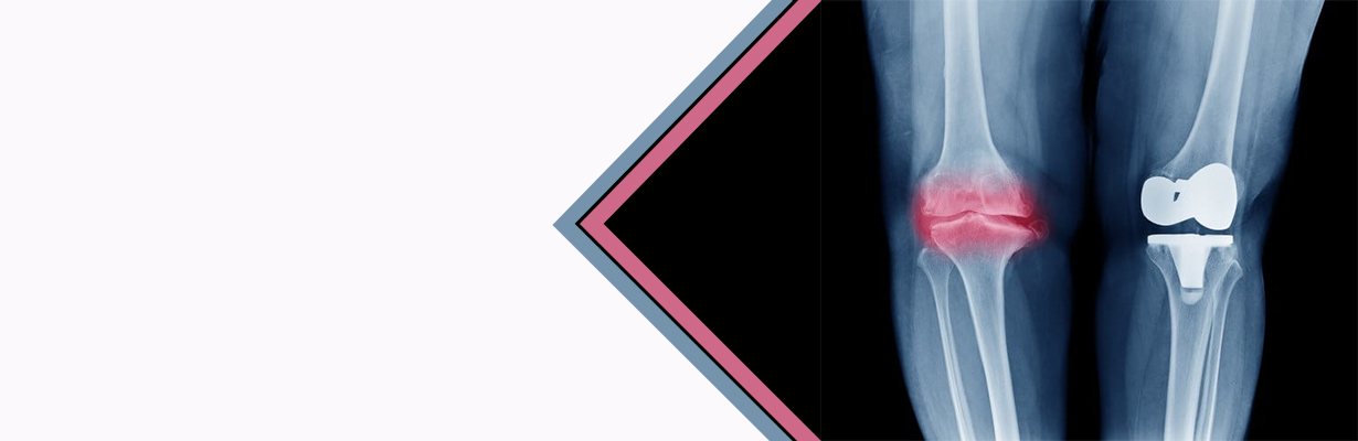 What is a total knee replacement?