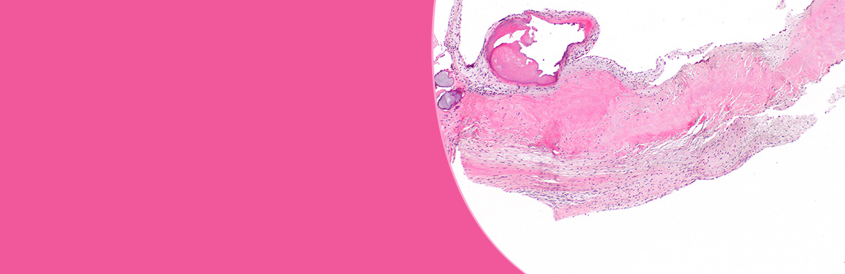 what-is-aortic-stenosis-dr-smita-mishra