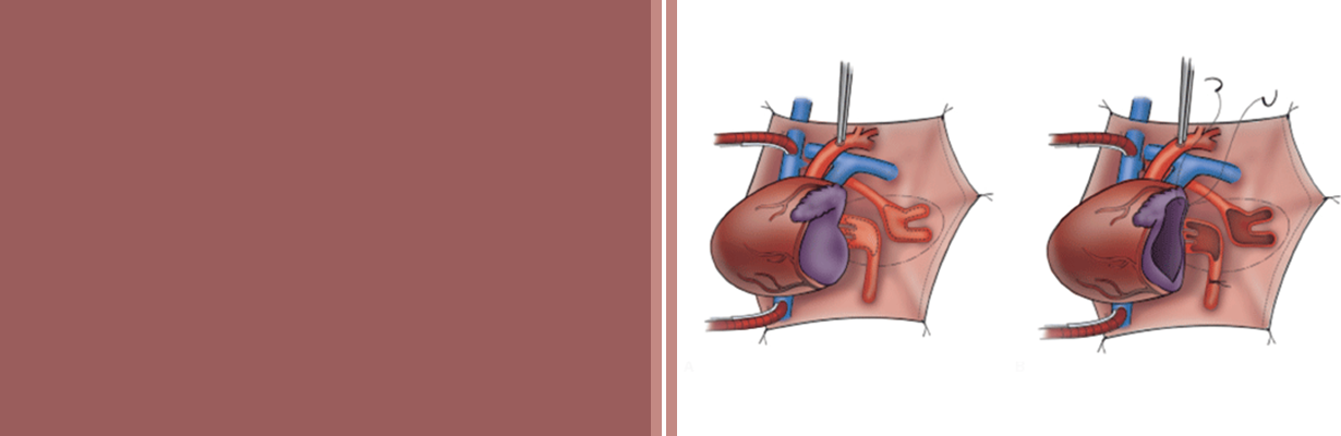 What is prognosis of TAPVC (Total anomalous pulmonary venous connection) type of cases?