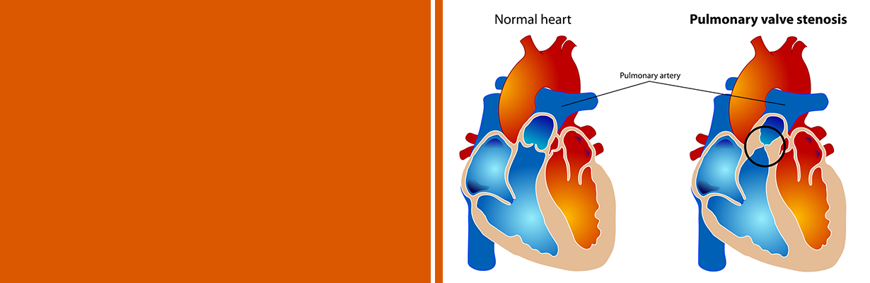 What is pulmonary stenosis?