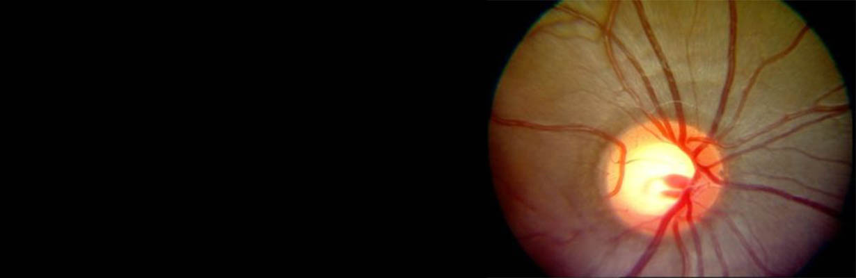 What is steroid induced glaucoma?