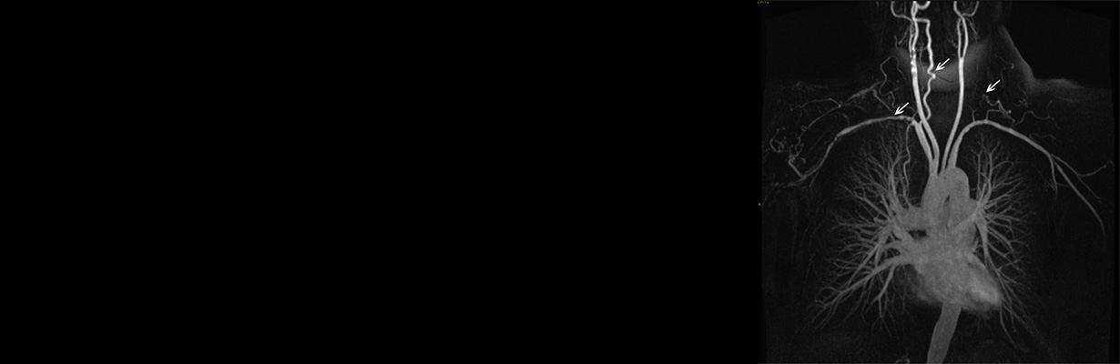 What is takayasu disease?