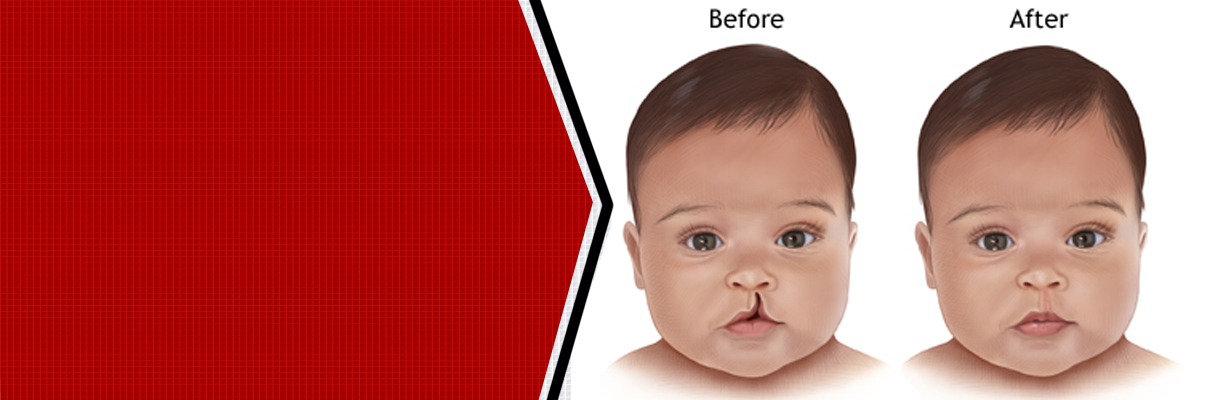 When should a child be operated upon for a cleft lip or a cleft palate?