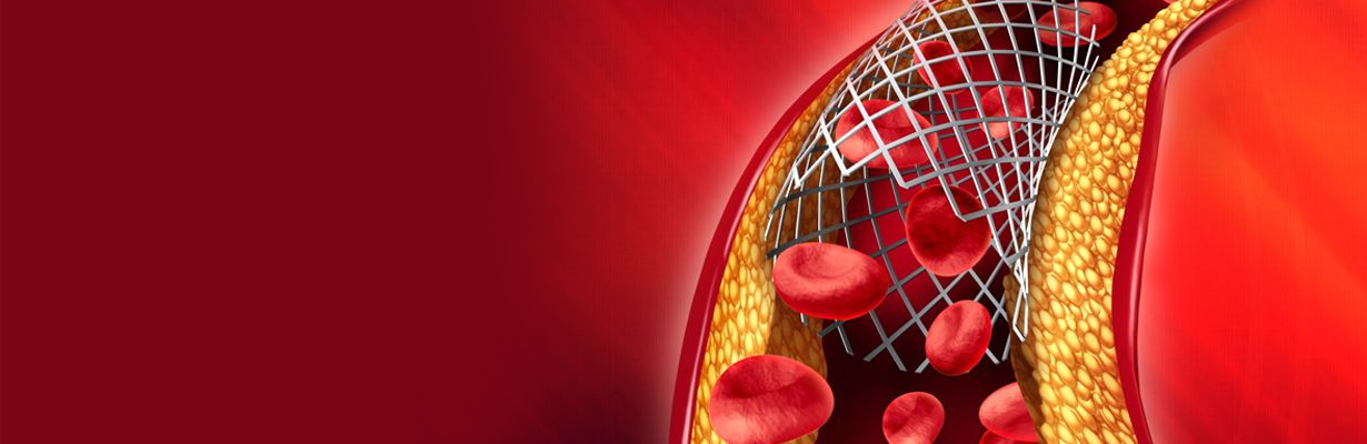 When should we use bare metal stents in acute MI?