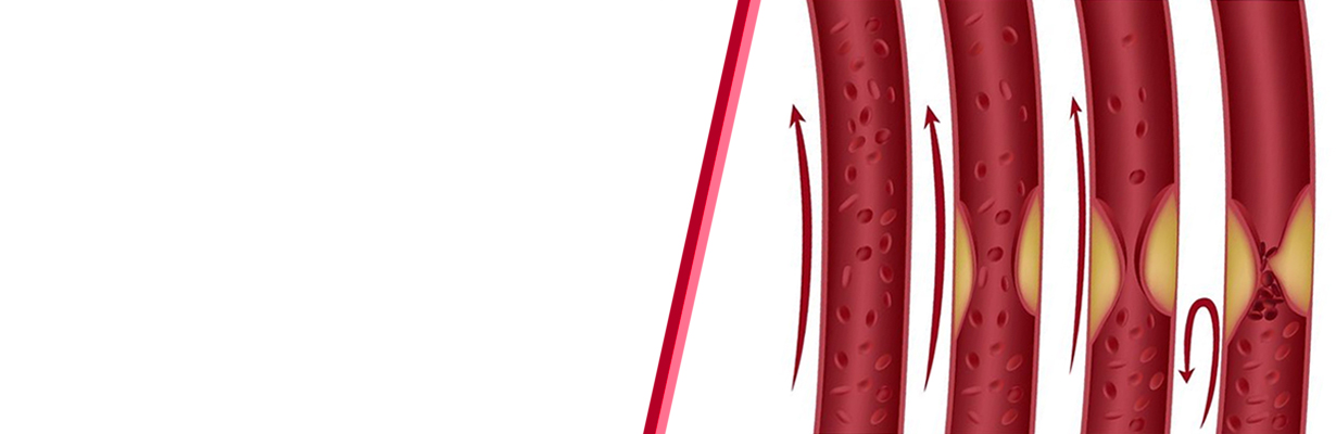 When to intervene when one artery of a patient is 100% is blocked?