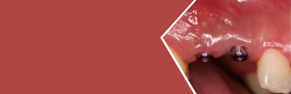 When do we a second stage surgery, for example after BT shunt when do we do a characteristic....?