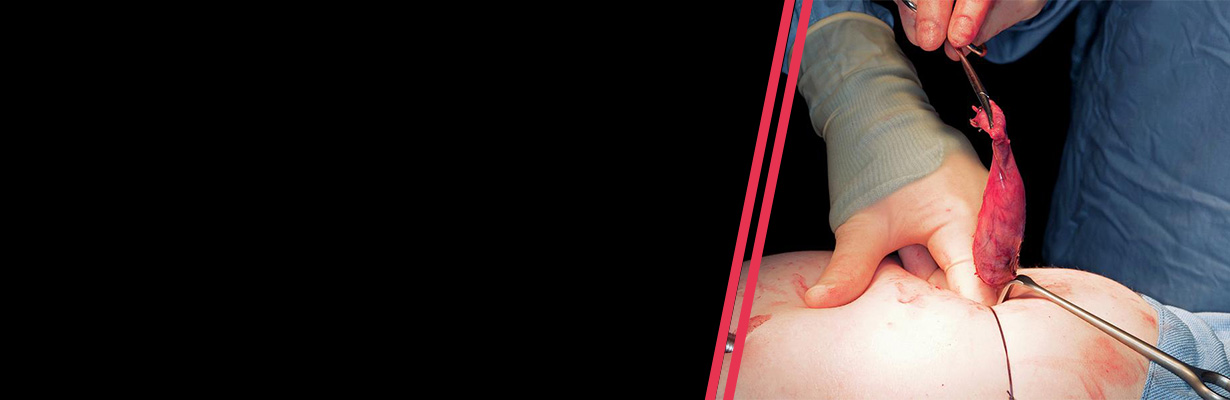 When should we remove gallbladder in a patient with acute cholecystitis?